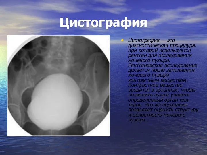 Цистография Цистография — это диагностическая процедура, при которой используется рентген для