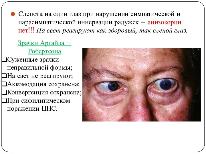 Слепота на один глаз при нарушении симпатической и парасимпатической иннервации радужек