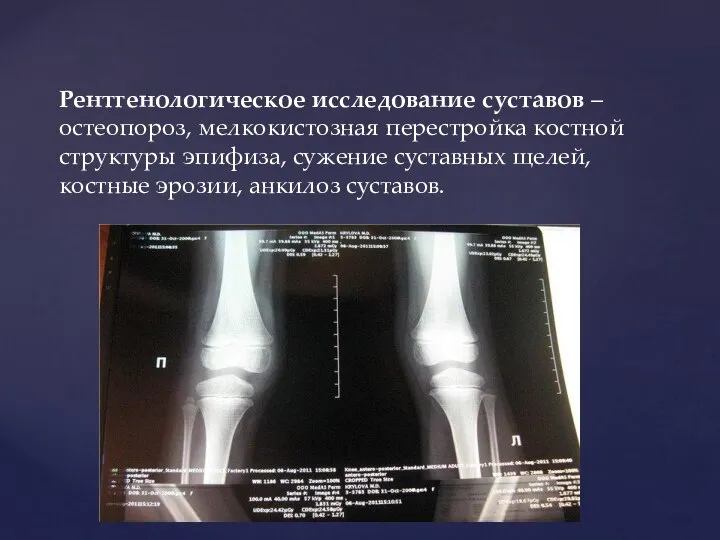 Рентгенологическое исследование суставов – остеопороз, мелкокистозная перестройка костной структуры эпифиза, сужение