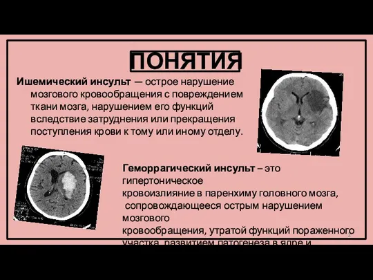 ПОНЯТИЯ Ишемический инсульт — острое нарушение мозгового кровообращения с повреждением ткани