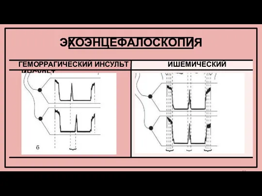 ЭХОЭНЦЕФАЛОСКОПИЯ ГЕМОРРАГИЧЕСКИЙ ИНСУЛЬТ ИШЕМИЧЕСКИЙ ИНСУЛЬТ