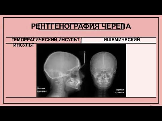 РЕНТГЕНОГРАФИЯ ЧЕРЕПА ГЕМОРРАГИЧЕСКИЙ ИНСУЛЬТ ИШЕМИЧЕСКИЙ ИНСУЛЬТ