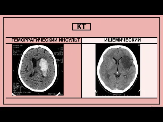 КТ ГЕМОРРАГИЧЕСКИЙ ИНСУЛЬТ ИШЕМИЧЕСКИЙ ИНСУЛЬТ