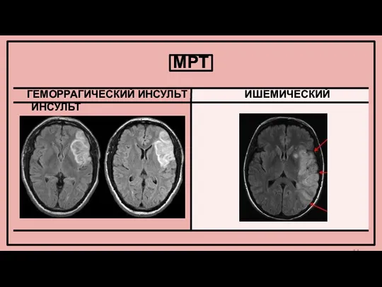 МРТ ГЕМОРРАГИЧЕСКИЙ ИНСУЛЬТ ИШЕМИЧЕСКИЙ ИНСУЛЬТ