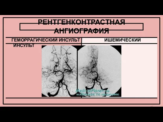 РЕНТГЕНКОНТРАСТНАЯ АНГИОГРАФИЯ ГЕМОРРАГИЧЕСКИЙ ИНСУЛЬТ ИШЕМИЧЕСКИЙ ИНСУЛЬТ