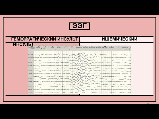 ЭЭГ ГЕМОРРАГИЧЕСКИЙ ИНСУЛЬТ ИШЕМИЧЕСКИЙ ИНСУЛЬТ