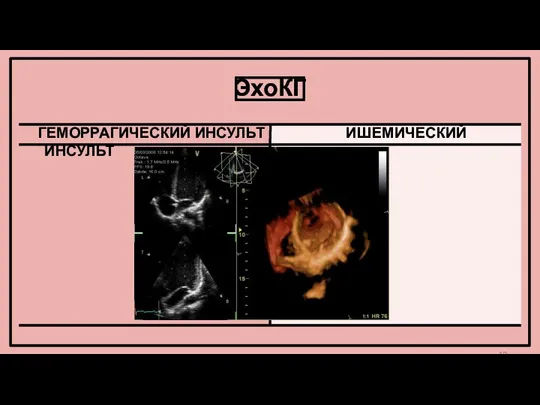 ЭхоКГ ГЕМОРРАГИЧЕСКИЙ ИНСУЛЬТ ИШЕМИЧЕСКИЙ ИНСУЛЬТ