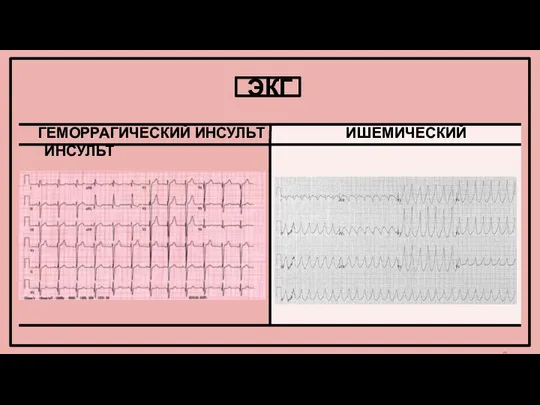 ЭКГ ГЕМОРРАГИЧЕСКИЙ ИНСУЛЬТ ИШЕМИЧЕСКИЙ ИНСУЛЬТ