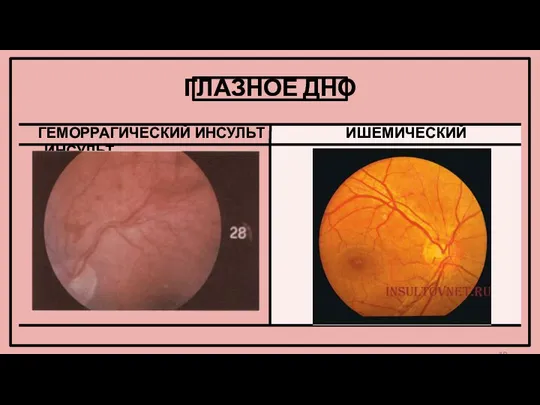 ГЛАЗНОЕ ДНО ГЕМОРРАГИЧЕСКИЙ ИНСУЛЬТ ИШЕМИЧЕСКИЙ ИНСУЛЬТ