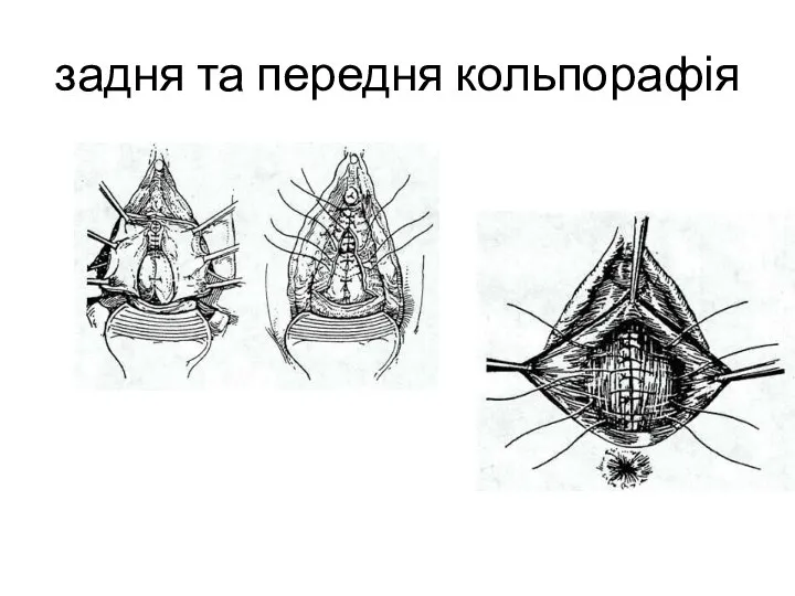 задня та передня кольпорафія