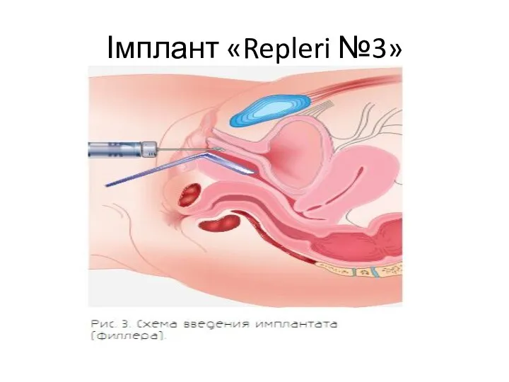 Імплант «Repleri №3»
