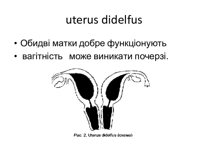 uterus didelfus Обидві матки добре функціонують вагітність може виникати почерзі.