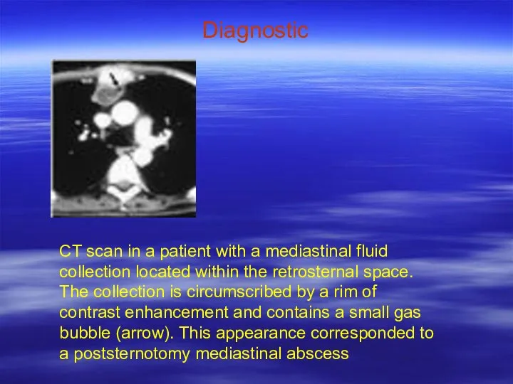 Diagnostic CT scan in a patient with a mediastinal fluid collection