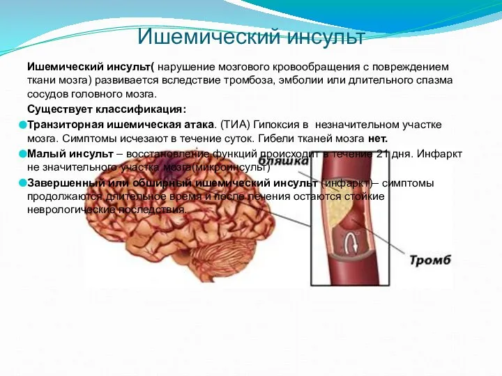 Ишемический инсульт Ишемический инсульт( нарушение мозгового кровообращения с повреждением ткани мозга)