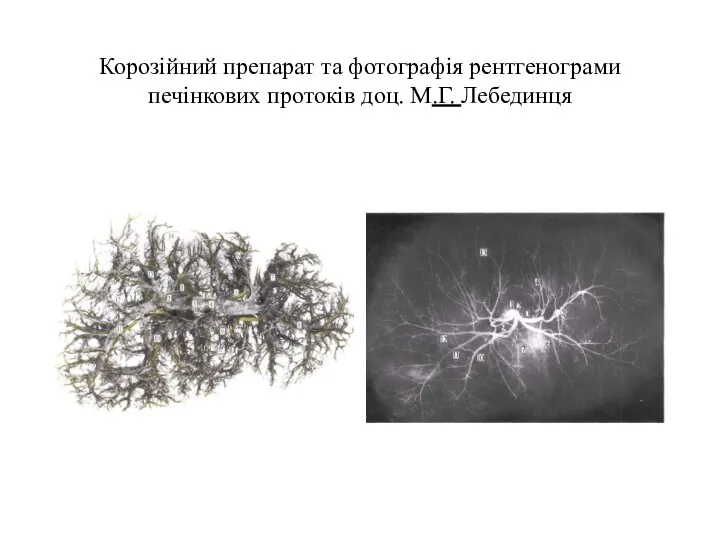 Корозійний препарат та фотографія рентгенограми печінкових протоків доц. М.Г. Лебединця