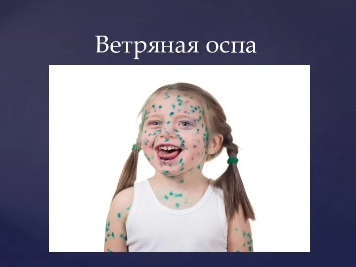 Ветряная оспа