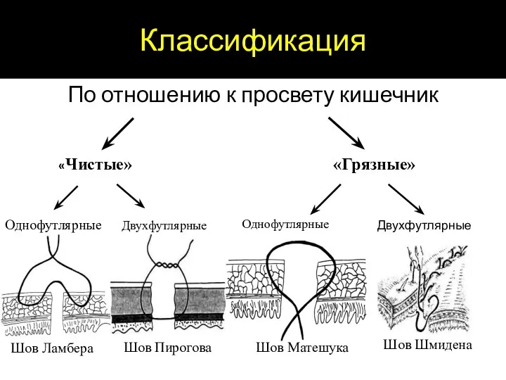 Классификация По отношению к просвету кишечник «Чистые» «Грязные» Однофутлярные Двухфутлярные Однофутлярные