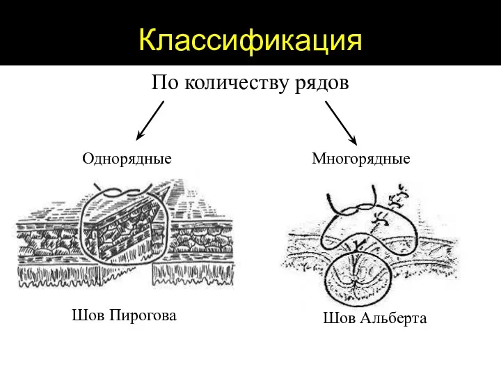 Классификация По количеству рядов Однорядные Многорядные Шов Пирогова Шов Альберта