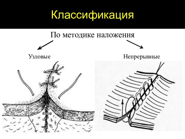 Классификация По методике наложения Узловые Непрерывные