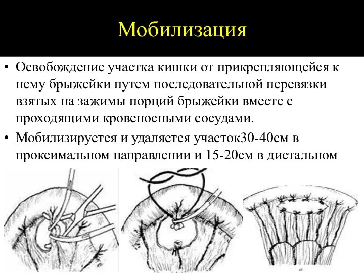 Мобилизация Освобождение участка кишки от прикрепляющейся к нему брыжейки путем последовательной