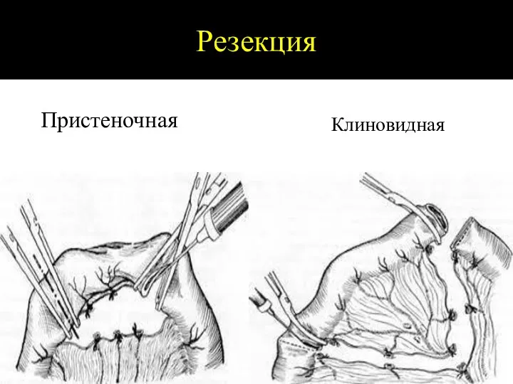 Резекция Пристеночная Клиновидная