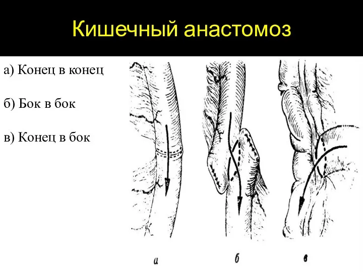 Кишечный анастомоз а) Конец в конец б) Бок в бок в) Конец в бок