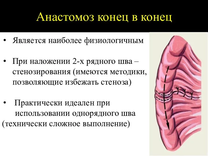 Анастомоз конец в конец Является наиболее физиологичным При наложении 2-х рядного