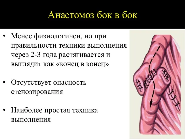 Анастомоз бок в бок Менее физиологичен, но при правильности техники выполнения