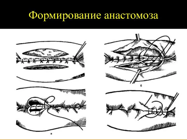 Формирование анастомоза