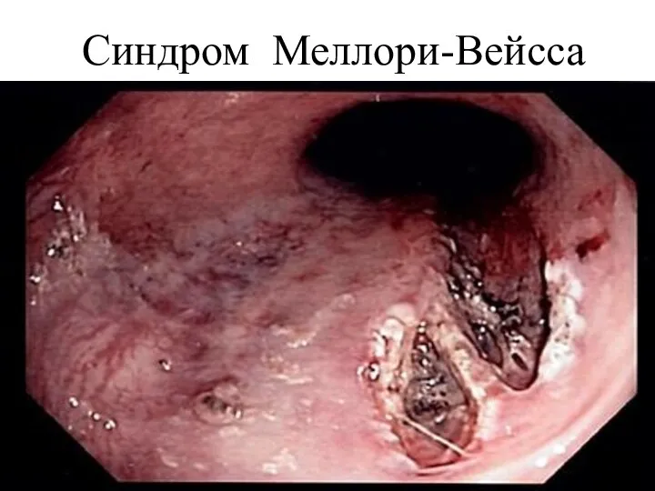 Синдром Меллори-Вейсса