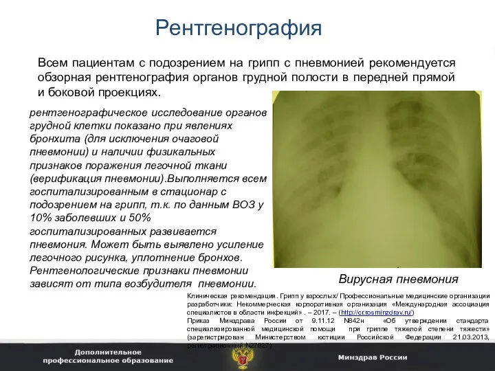 Рентгенография Всем пациентам с подозрением на грипп с пневмонией рекомендуется обзорная