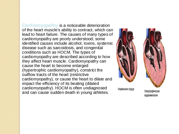 Cardiomyopathy is a noticeable deterioration of the heart muscle's ability to