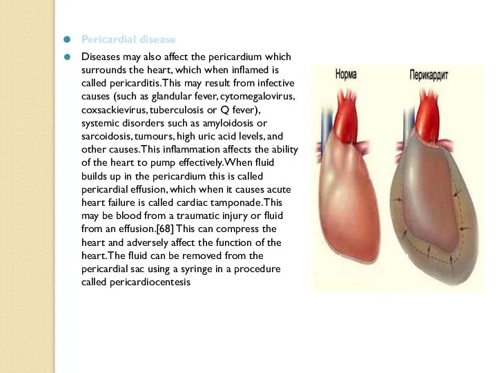 Pericardial disease Diseases may also affect the pericardium which surrounds the