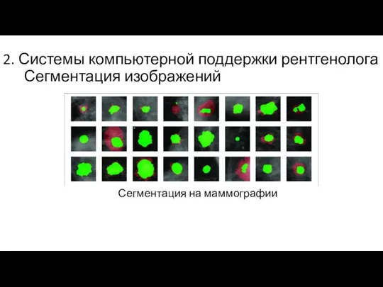 2. Системы компьютерной поддержки рентгенолога Сегментация изображений Сегментация на маммографии