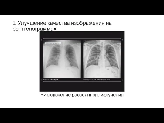 1. Улучшение качества изображения на рентгенограммах Исключение рассеянного излучения