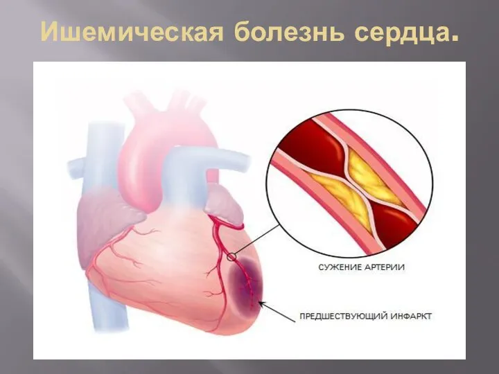 Ишемическая болезнь сердца. По современной классификации к ИБС относятся внезапная смерть,