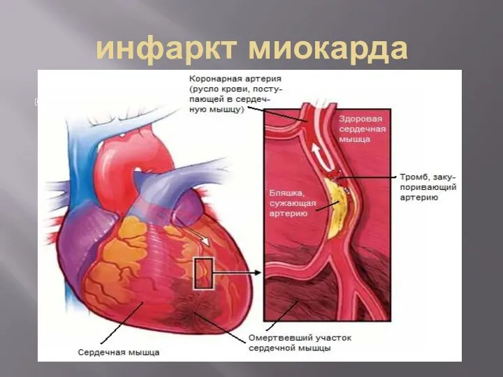 инфаркт миокарда Инфаркт сердца (инфаркт миокарда) является одной из ведущих причин