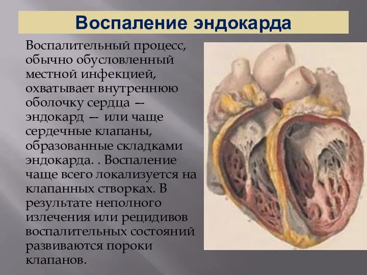 Воспаление эндокарда Воспалительный процесс, обычно обусловленный местной инфекцией, охватывает внутреннюю оболочку