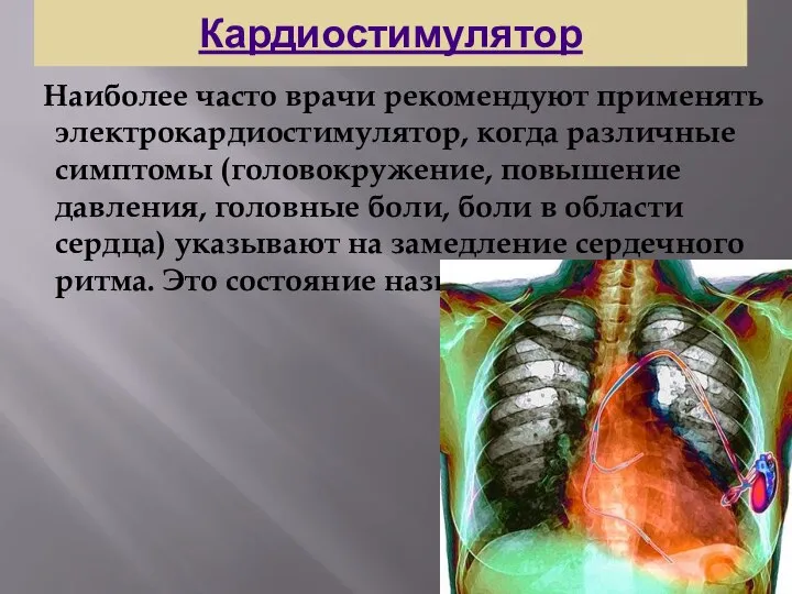 Кардиостимулятор Наиболее часто врачи рекомендуют применять электрокардиостимулятор, когда различные симптомы (головокружение,