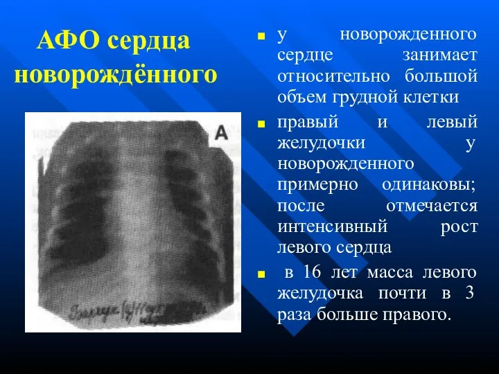 АФО сердца новорождённого у новорожденного сердце занимает относительно большой объем грудной