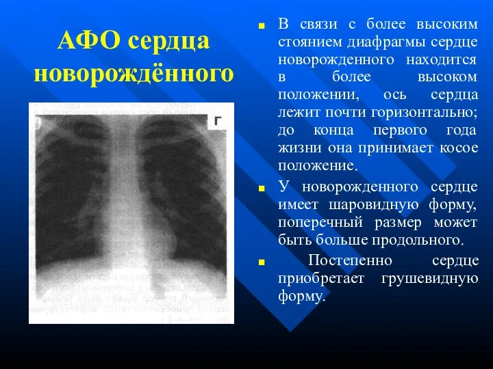 АФО сердца новорождённого В связи с более высоким стоянием диафрагмы сердце