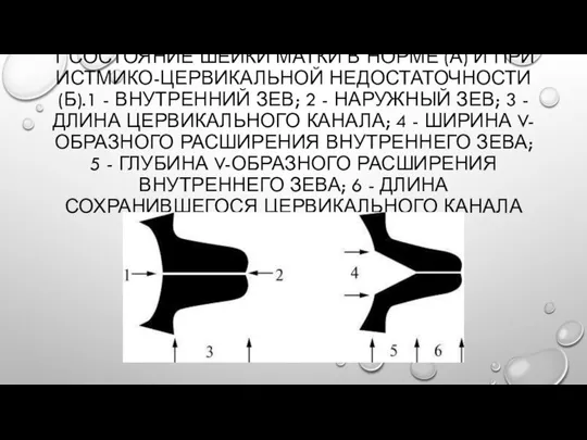 1 СОСТОЯНИЕ ШЕЙКИ МАТКИ В НОРМЕ (А) И ПРИ ИСТМИКО-ЦЕРВИКАЛЬНОЙ НЕДОСТАТОЧНОСТИ