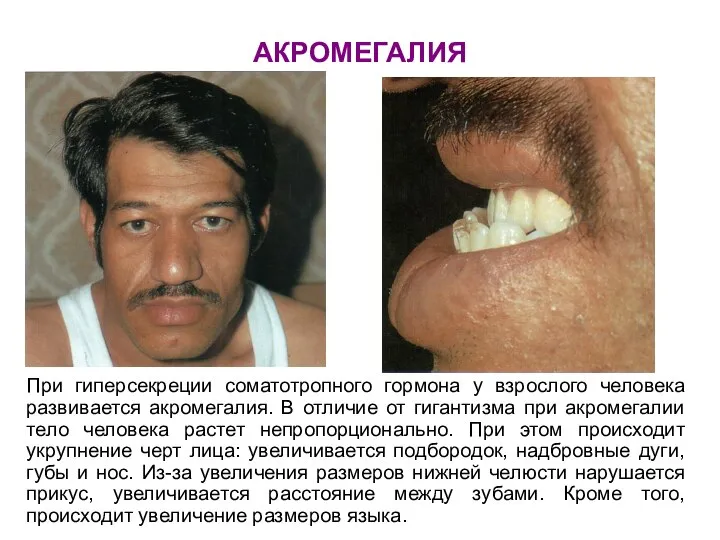 АКРОМЕГАЛИЯ При гиперсекреции соматотропного гормона у взрослого человека развивается акромегалия. В