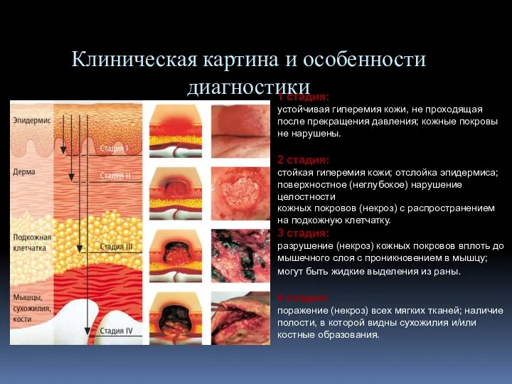 Клиническая картина и особенности диагностики 1 стадия: устойчивая гиперемия кожи, не