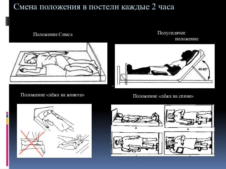 Смена положения в постели каждые 2 часа Положение Симса Положение «лёжа