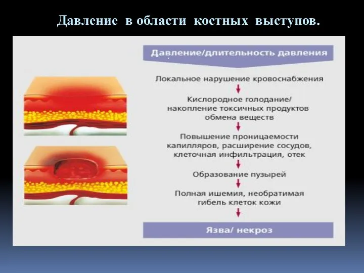 Давление в области костных выступов. .