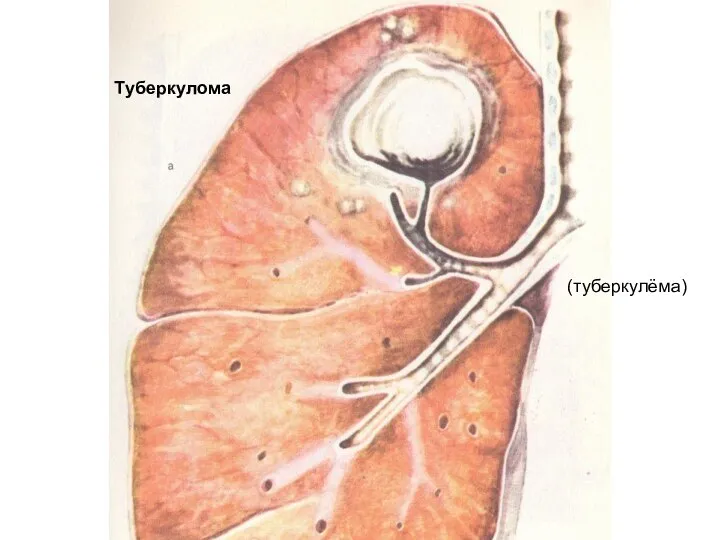 (туберкулёма) Туберкулома