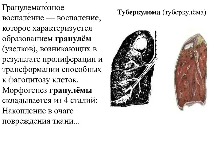 Туберкулома (туберкулёма) Гранулемато́зное воспале́ние — воспаление, которое характеризуется образованием гранулём (узелков),