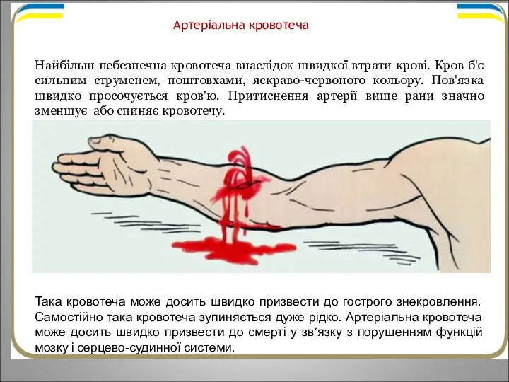 Артеріальна кровотеча Найбільш небезпечна кровотеча внаслідок швидкої втрати крові. Кров б'є