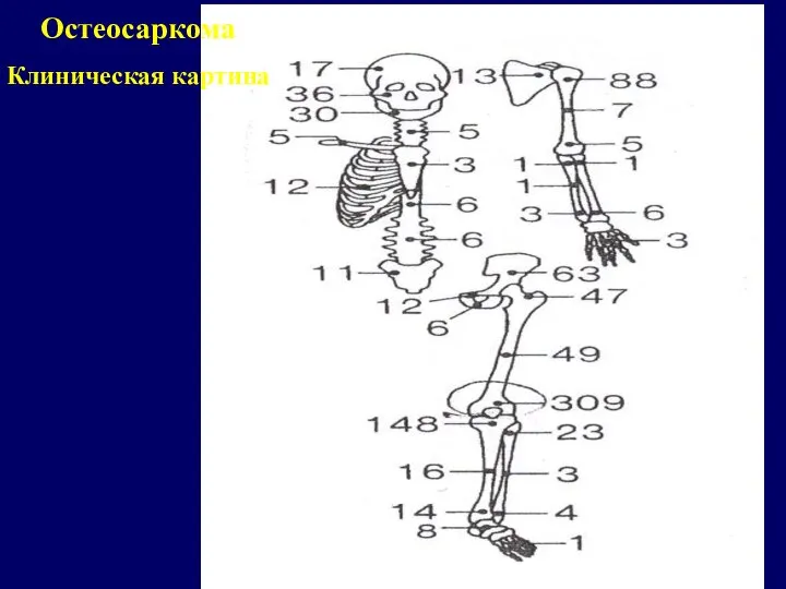 Остеосаркома Клиническая картина